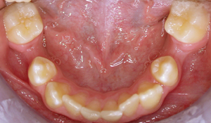 hypodontia before treatment